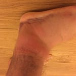 Acute ankle sprain and what to do about it.