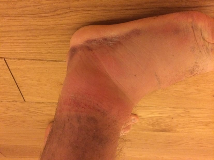 Acute ankle sprain and what to do about it.