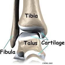 What you need to know about Total Ankle Replacement surgery