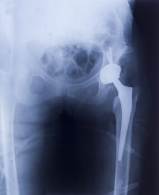 Hip Pain