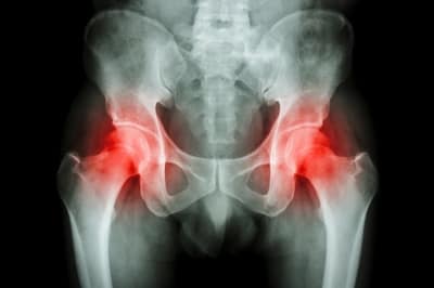 Arthritis in Adults and Children and what to do about it