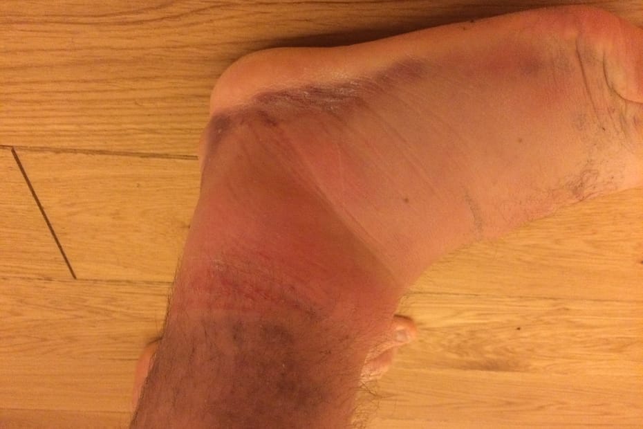 Acute ankle sprain and what to do about it.